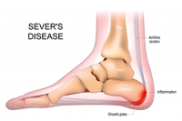 Sever’s Disease and How to Find Relief