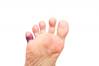 What is a Tailor’s Bunion?
