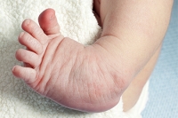 Clubfoot Affects Males More Than Females