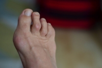 Facts About Hammertoe