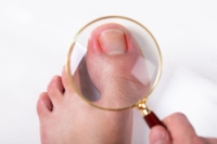 Risk Factors for Ingrown Toenails