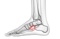 What Is a Nutcracker Fracture?