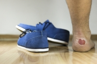 Larger Blisters May Need to Be Drained
