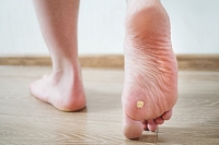 Understanding Warts on the Feet