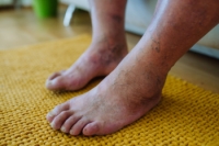 Saving Limbs With Diabetic Foot Care